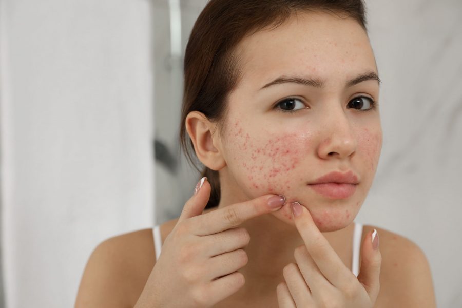 Pele Acneica: Como prevenir a acne e cuidar desse tipo de pele